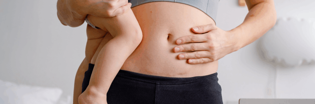 Mother holding her baby while showing a healed C-section scar on her abdomen.